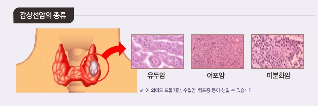 여성질환: 갑상선암 - 원인, 초기증상, 완치율.