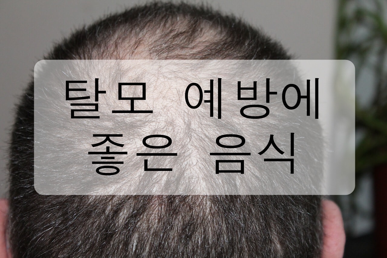 탈모 예방에 좋은 음식을 알아보자!