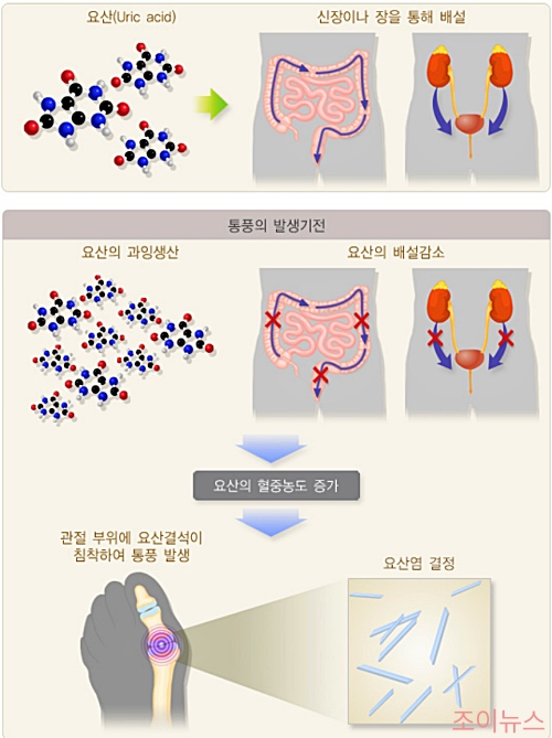 요산과 통풍_출처:질병관리청