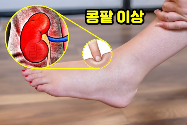 콩팥 건강 테스트, 체액저류, 오목부종, 팁줌