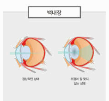 백내장 사진