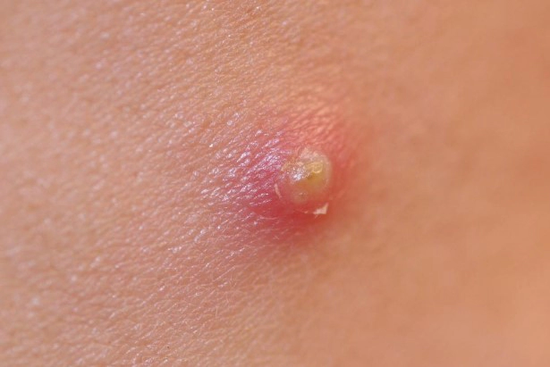 화농성 여드름 관리법 총정리