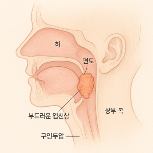 구인두암-조기 치료