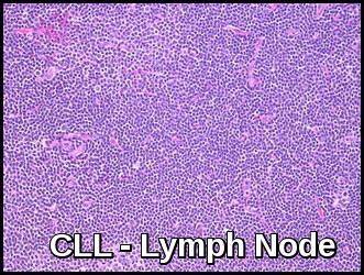 만성 림프구성 백혈병(CLL)의 Rai/Binet 병기 분류 체계