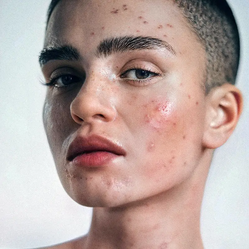 중년 여성 피부장벽 무너질 때 생기는 기미·잡티, 이렇게 회복하세요