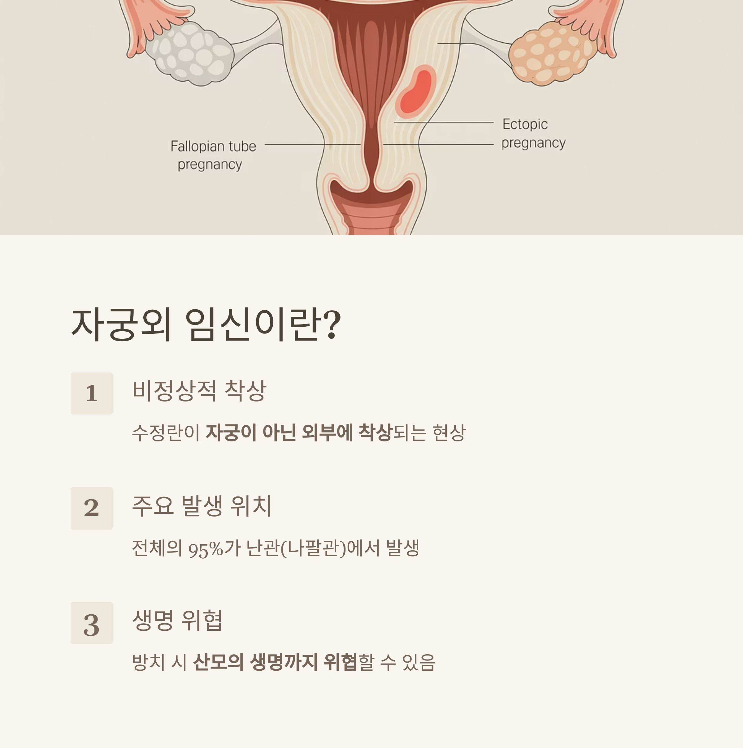 자궁외 임신이 발생하는 위치를 보여주는 해부학적 일러스트와 함께, 자궁외 임신의 정의와 생명 위험성 안내