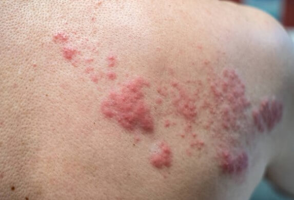 대상포진 초기증상 대상포진 조기치료 대상포진 초기증상 및 조기치료