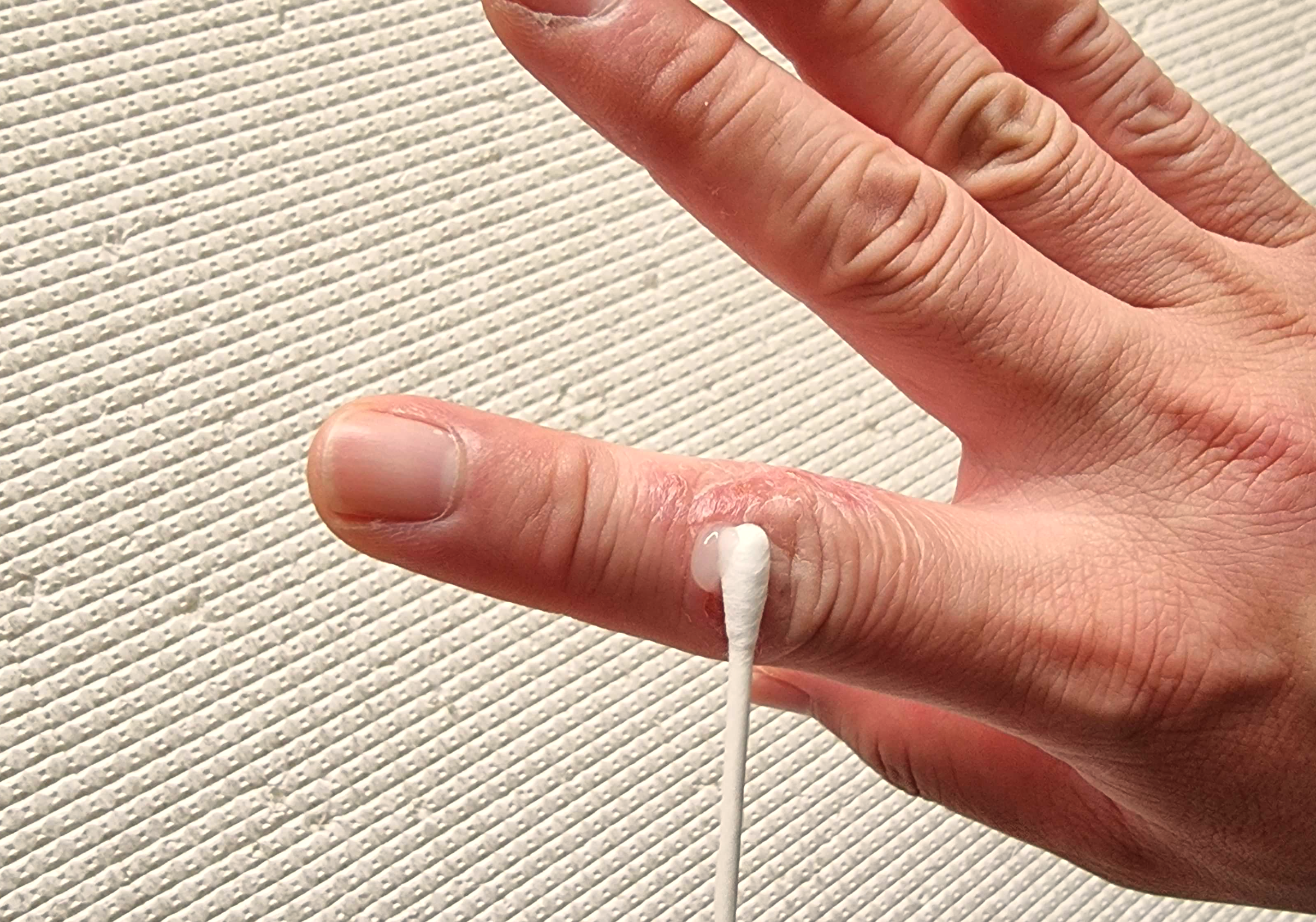 면봉을 이용해 손가락에 후시딘을 바르고 있습니다.