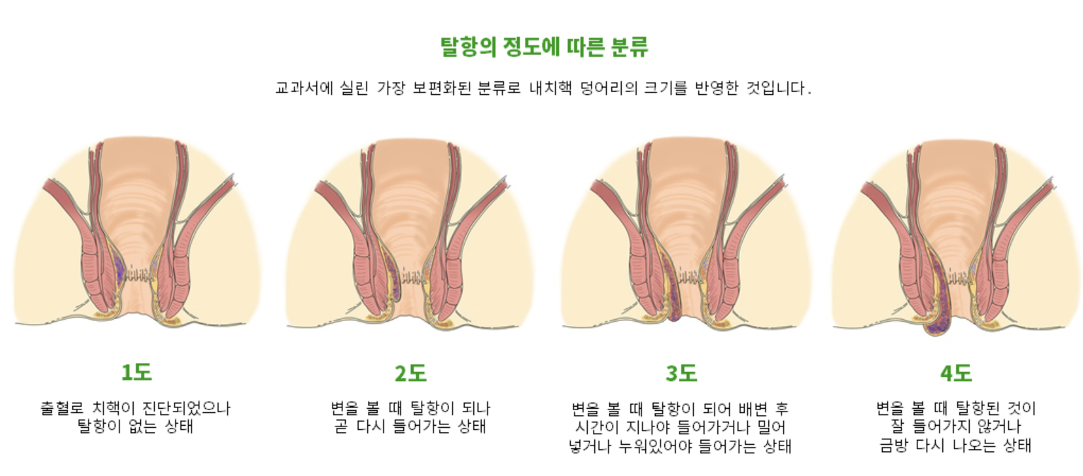 치질 증상 1