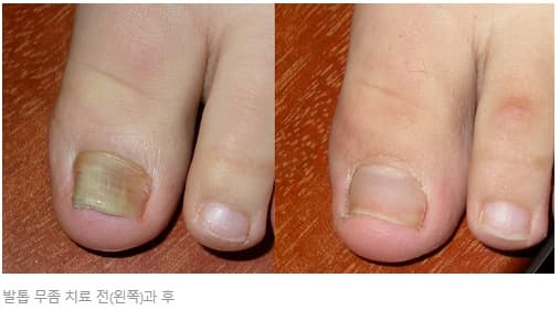 발톱무좀-치료