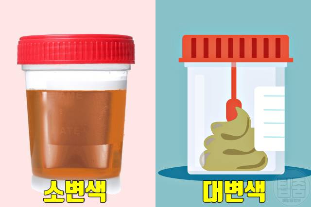담석증 증상 초기증상 소변색 대변색