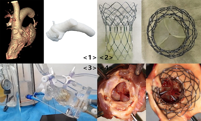대동맥판막 협착증