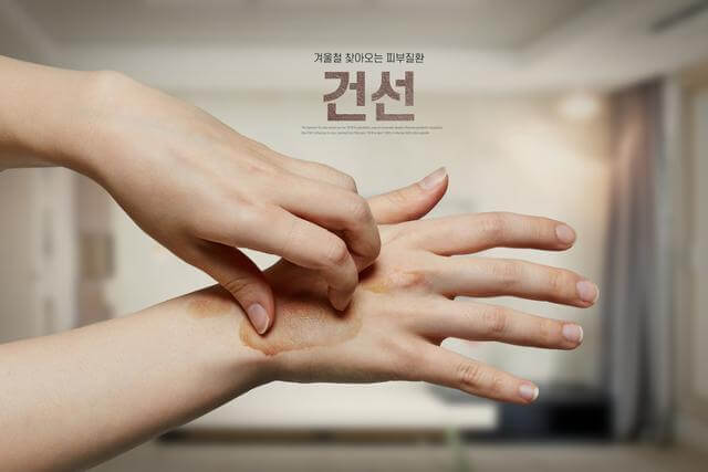 건선-원인-스트레스와-세균감염