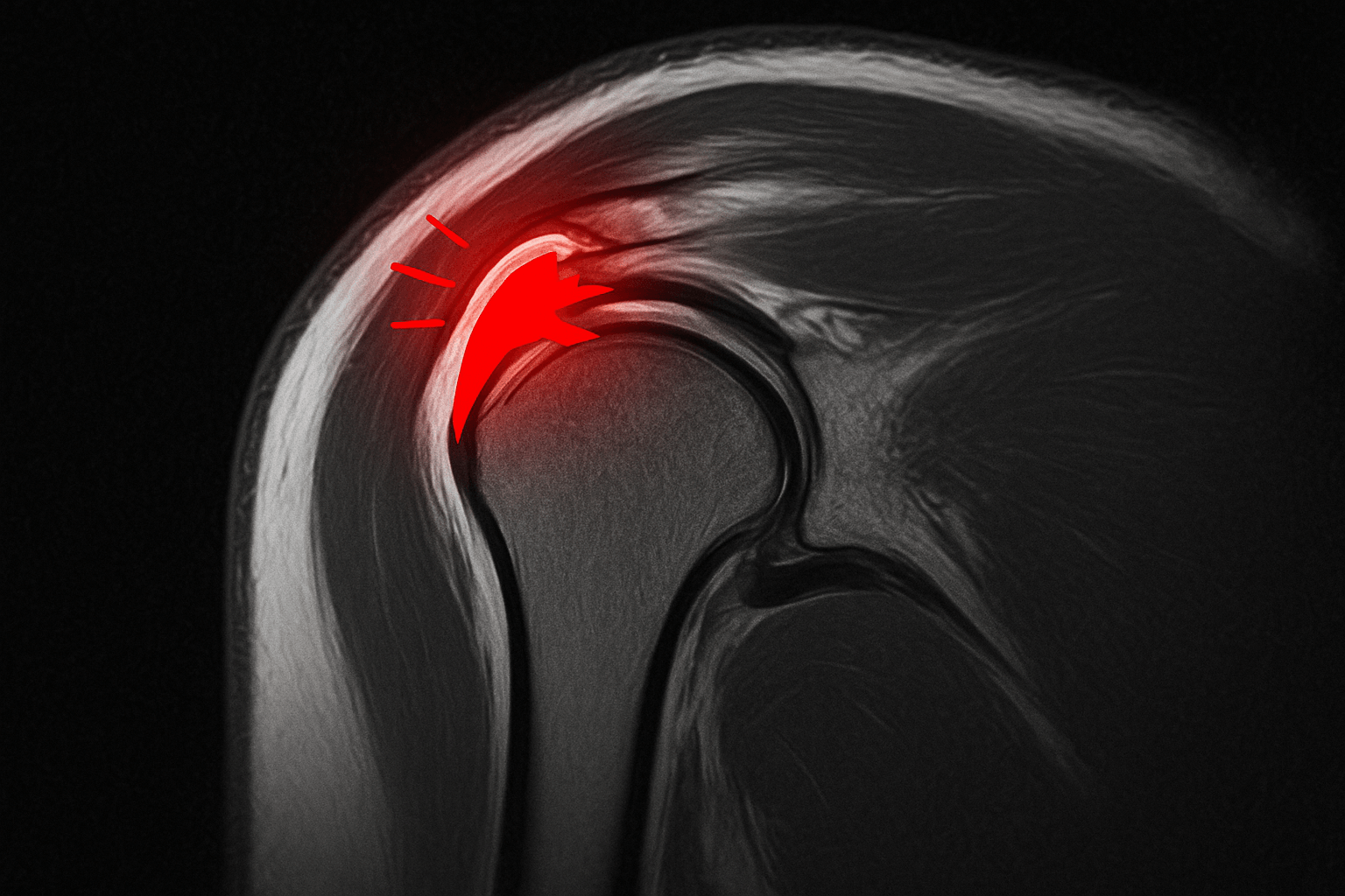 회전근개 파열 정확한 진단이 중요한 이유