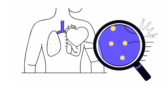 고지혈증 치료과정