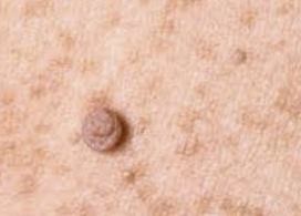 쥐젖 제거방법 4