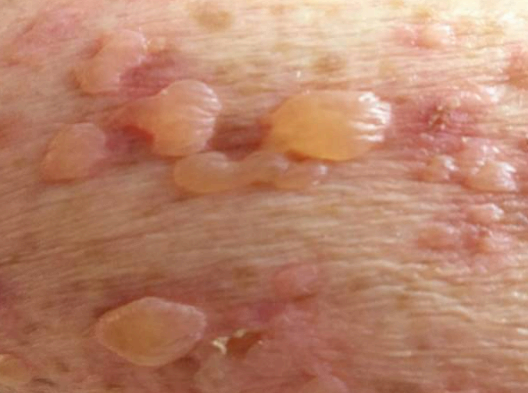 대상포진 증상 수포 사진