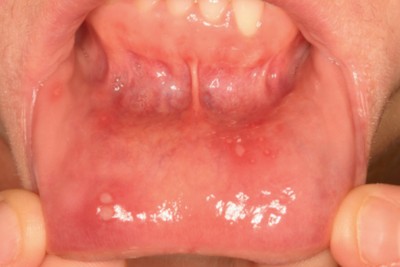 아프타성-구내염