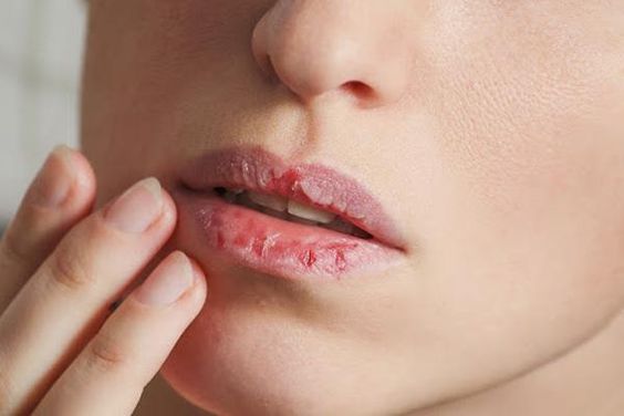 입술이 마르는 이유 입술 건강 상태 입술 갈라짐 마름 치료법