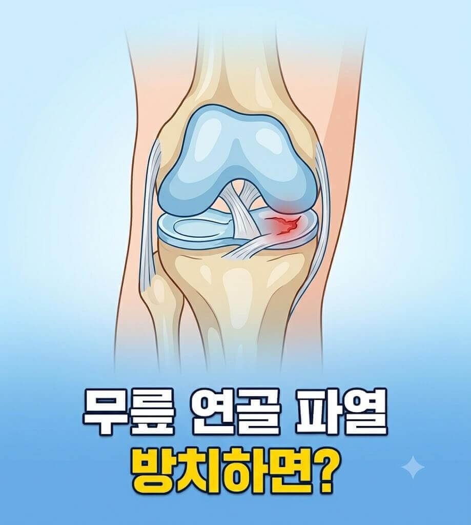 반월상연골판 파열을 보여주는 인포그래픽