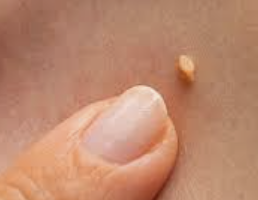 쥐젖 제거방법 7