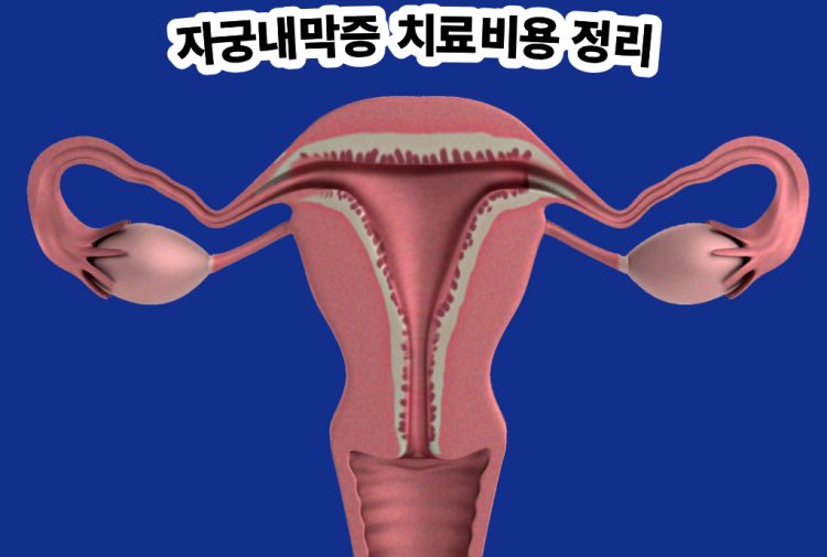 자궁내막증 치료비용 정리
