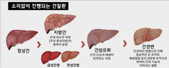 간경변 관련 사진