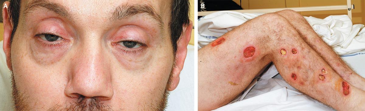 보툴리누스 중독