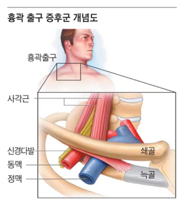 새끼 손가락 저림