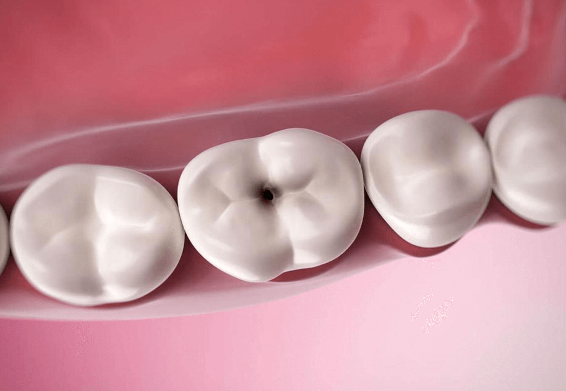 충치 치료 안하면