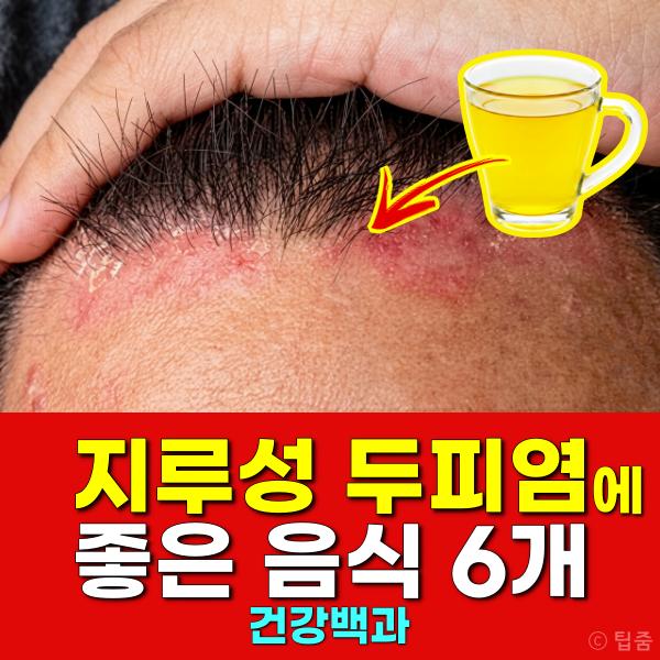 지루성 두피염 좋은 음식