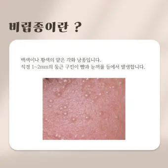 비립종 생기는 이유 비립종 없애는 방법 피부 관리법_3