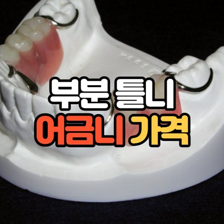 어금니 부분 틀니 가격