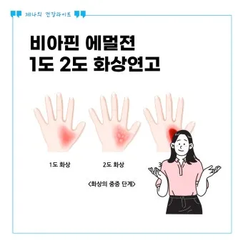 2도 화상 증상 자가치료 회복기간 응급처치법 정리_6