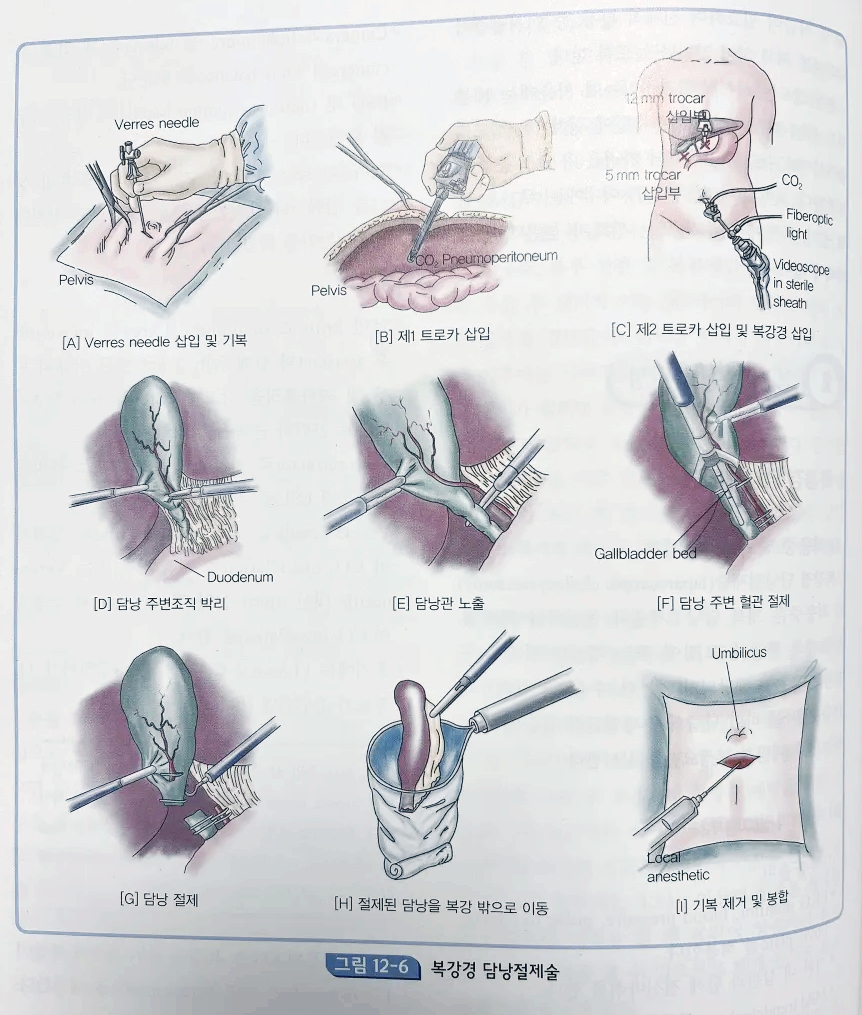 복강경 담낭 절제수술 과정을 그림으로 나타냄