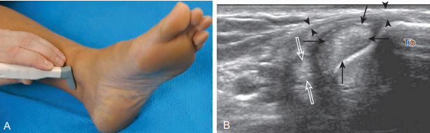 안쪽 발목 검사