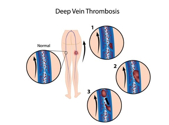 심부정맥 혈전증
