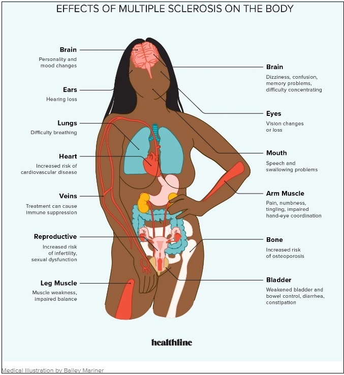 다발성&nbsp;경화증(MS): 증상&#44;&nbsp;원인 및&nbsp;치료&nbsp; The Essential Guide to Multiple Sclerosis: Symptoms&#44; Causes&#44; Treatments&#44; and Natural Approaches