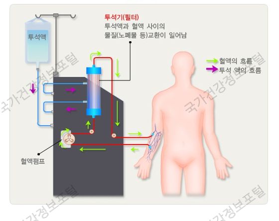 신장혈액투석이란