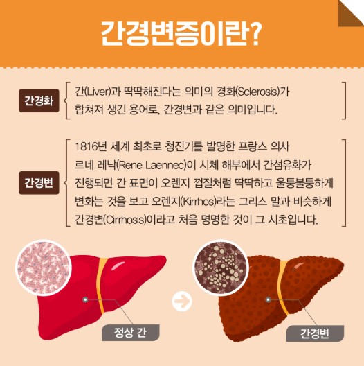 간경변증이란?