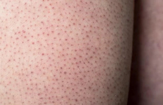 모공각화증 치료 방법 7가지