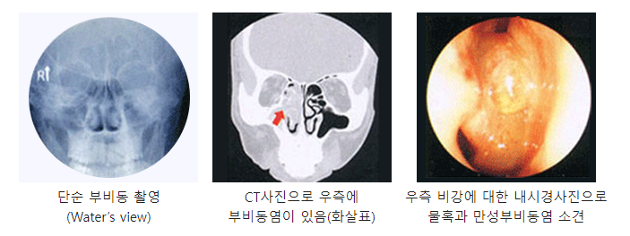 부비동치료방법