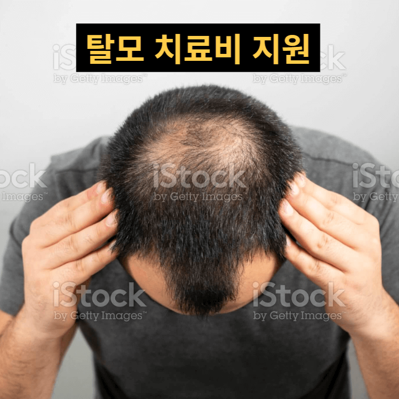 보령시 탈모 치료비