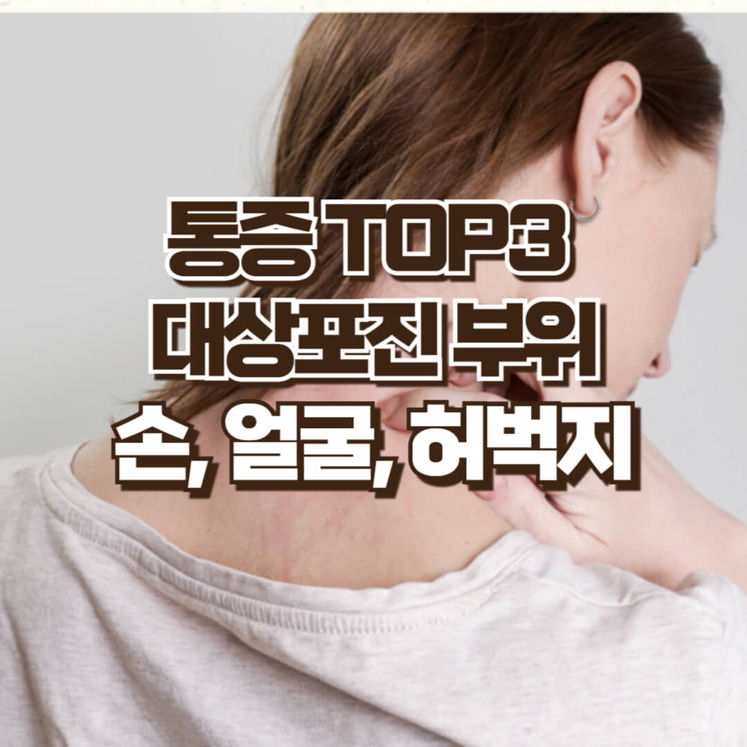 대상포진 부위별 증상