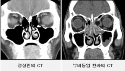 부비동염