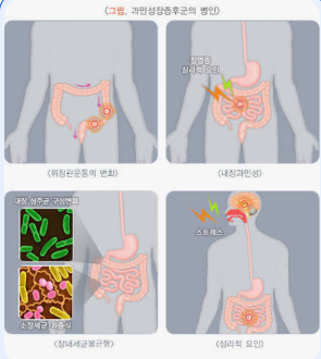 과민성대장증후군