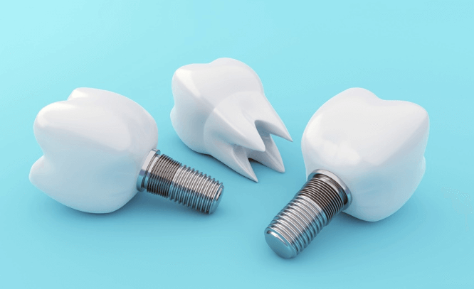 임플란트 보철재 비교 총정리 (Gold PFM Zirconia )