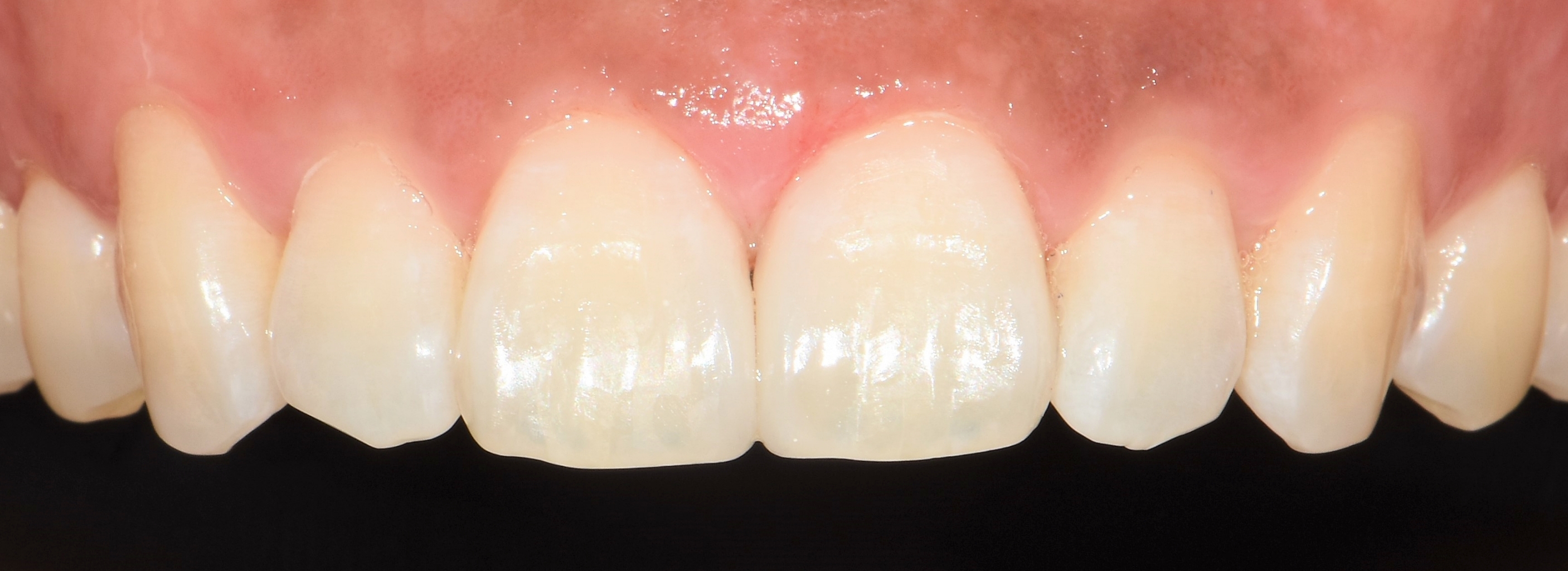 치아 삭제 없이 레진 빌드업 치료를 완료하여 벌어진 틈이 자연스럽게 메워진 앞니의 최종 결과 사진