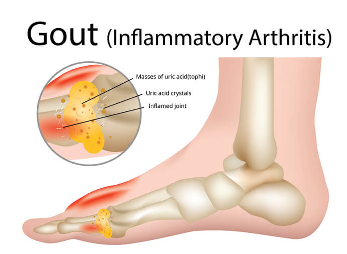 통풍과 요산의 관련성 그리고 임상결과들