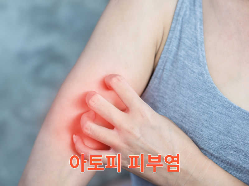 아토피 피부염의 원인과 증상 해결방법